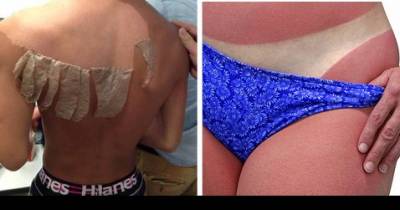 Do You Know What Really Causes That Sunburn?