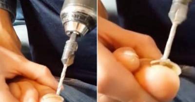 Diy 'Doctor' Performs Stomach-churning 'Operation' To Remove His Damaged Toe Nail