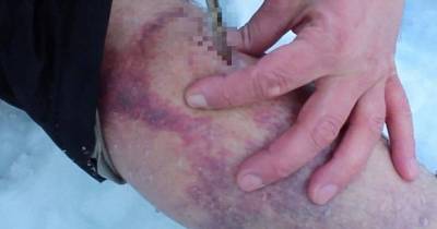 Incredible Video Shows Russian Hiker Performing Surgery On Himself On The Mountainside