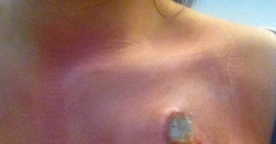 This Young Woman's Life Changed Forever When Her Pacemaker Wouldn't Stay Where The Doctors Put It!