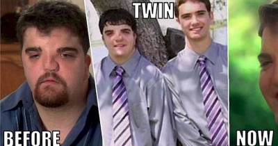Man Spends 2 Million Dollars To Look Like His Twin Brother Again