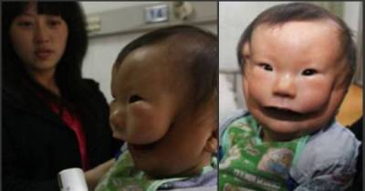A Tragic Mistake Led To This Boy Being Born With A Double Face
