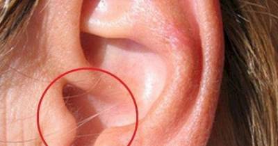 Ear Hairs May Predict Whether You Will Develop Heart Disease