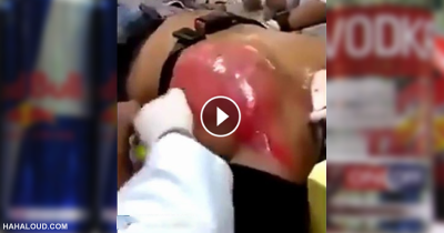 Man Drank 24 Cans Of Red Bull, His Heart Literally Inflated Like A Balloon And About To Pop Out Of His Chest!