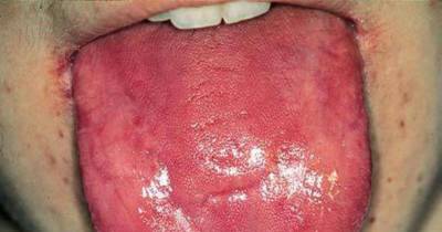 Look At Your Tongue. If It Looks Odd You Might Be In Trouble.