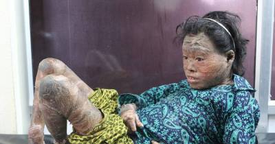 Girl With Painful Skin Condition Can Now Move and Talk Thanks To Vaseline