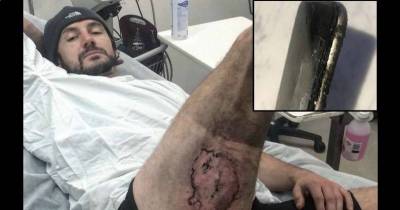 Cyclist Suffers Severe Burns When His iPhone Explodes In His Pocket