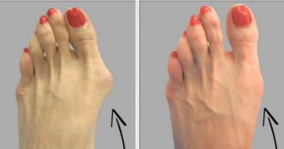 Here&rsquo;s How To Get Rid Of Bunions Completely Natural!