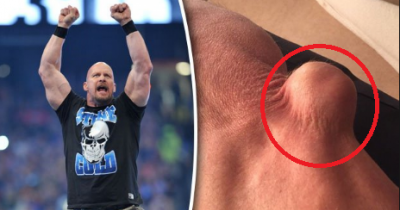 WWE&rsquo;s Steve Austin Shows Off Shocking Elbow Injury