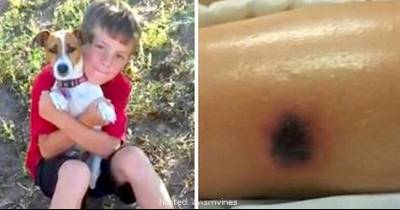 This Little Boy Died After This Strange Rash Appeared On Him