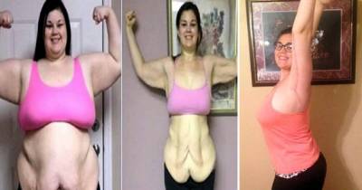 She&rsquo;s Supposed To Get A Stomach Reduction But Instead She Shocks Her Doctors With Her Weight Loss