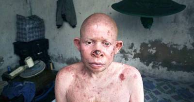 Albino Hunt In Africa: Black Market Fuels Hunt For Albino Body Parts