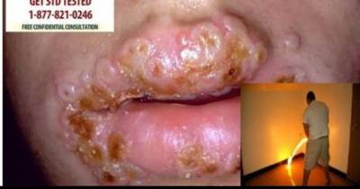 Common STDs Becoming Resistant To Treatments.
