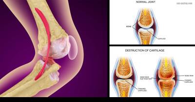 How You Can Strengthen Damaged Knee Joints and Heal The Pain In Your Knees Naturally, Without Surgery or Pills