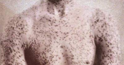 The News Just Keeps Getting Worse And Worse In Siberia...Now Smallpox?!