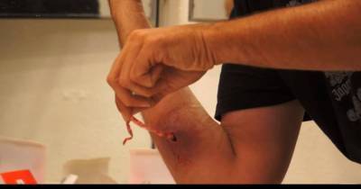 Super Long Piece Of Gauze Is Pulled From A Spider Bite