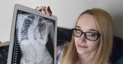 Teen Has A Bizarre Curve In Her Spine, Then A TV Show Unexpectedly Leads Doctors To Diagnosis