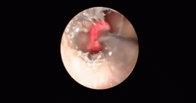 Sickening Images Of Things Being Pulled Out Of Noses.
