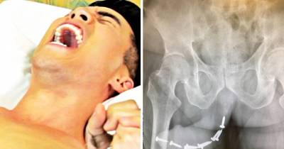 Girlfriend Shoves 12 Screws In Her Man's Johnson After He Passing Out Drunk