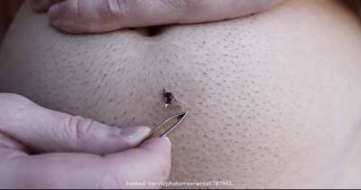 The Longest Ingrown Hair You've Ever Seen
