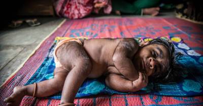 Indian Mother Heartbroken As Her Baby Is A &ldquo;Werewolf In Making&rdquo;