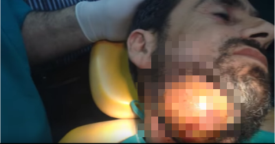 This Poor Guy Goes Through Hell As Stuff Gushes From This Gigantic, Softball Sized Abscess On His Face