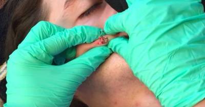 Simply The Worst Pimple-bursting Clip You Are Ever Likely To See