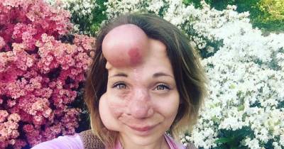 This Lady Was Born With Frightening Tumors That Made Her Life A Tragedy