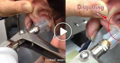 This Guy Experiences Sharp Pain In His Ear. What Comes Out Is Nasty AF
