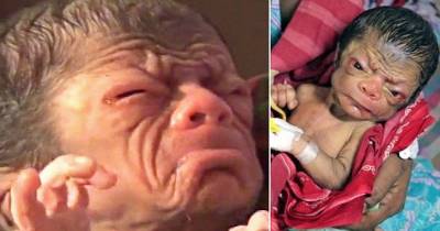 Rare Aging Condition : The Newborn Who Looks Like An 80-year-old