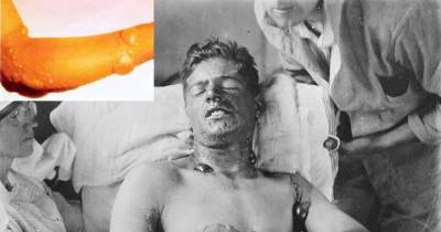 If You Don't Know Much About Mustard Gas, You'll Be Horrified By Its Effects