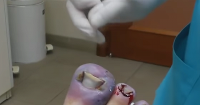 The Most Disgusting Ingrown Toenails You'll Ever See Get Surgery