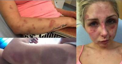 This Woman Posted The Injuries Caused By Her Ex To Warn Other Girls What It's Like Dating Him