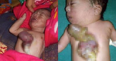 Shocking: These Babies Were Born With Their Heart Outside Their Chest