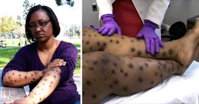 Woman Thinks She Got Bit While Mowing Her Lawn, Then Mysterious Round Dots Cover Her Body