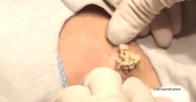 Dr Pimple Popper Removes Giant Cheesy Cyst From Woman's Back