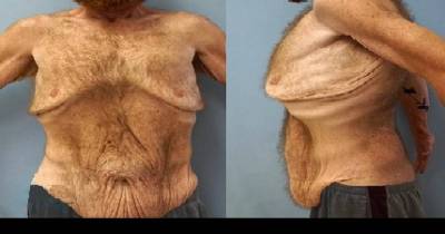 Man Who Lost Over 300 Pounds Undergoes Massive Skin Removal Surgery Requiring 2,400 Stitches