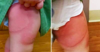 Mom Notices A Scary Rash On Her Toddler's Legs Thanks To Apple Jacks Cereal