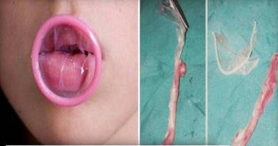 Woman Who Swallowed Condom While Orally Pleasing Her Boyfriend Went Through Surgery