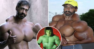 Bodybuilder Injects Oil Into His Muscles To Look Like The Incredible Hulk