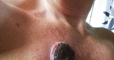 This Cancer 'Treatment' Burns Holes In Your Skin