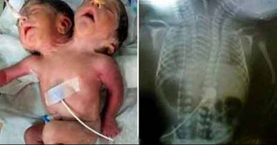 Two-Headed Baby Boy Born In India