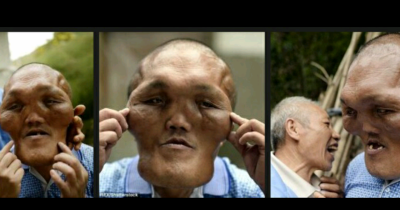Man Born With &ldquo;Alien Face&rdquo; Seeking Help For Facial Surgery