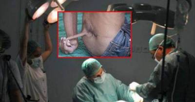 A Boy With 18cm Long Tail Finally Has The Growth Removed After It Became Painful For Him To Sit Or Sleep!