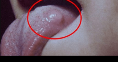 How To Recognize The Symptoms Of Tapeworm Infection And Eliminate It