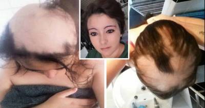 Girl Suffers So Much Stress In 'Toxic' Relationship That She Goes Bald