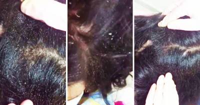 Woman Show Off Her Horrible Case of Head Lice
