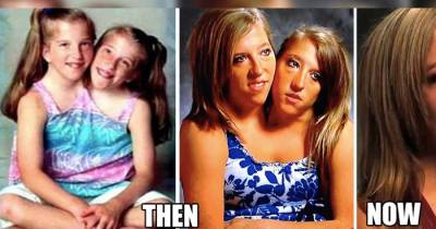 Unusual Facts About Famous Conjoined Twins Abby And Brittany Hensel