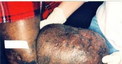 This Is What Happens When You Have Elephantiasis, And It's Completely Awful