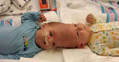 These Conjoined Twins Underwent A 16-Hour-Long Surgery To Separate Them